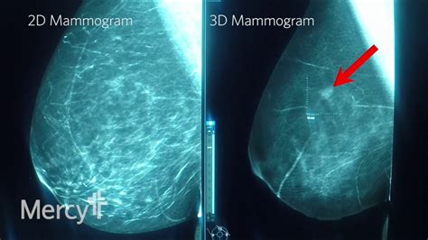 Learn About the Two Main Types of Mammograms.